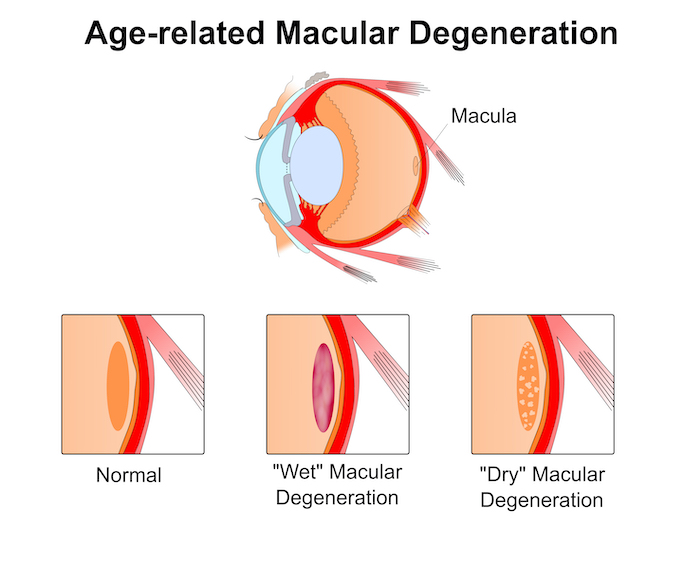Macular Degeneration diagram